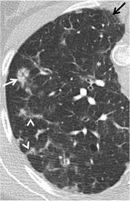 Granulomatous-Lymphocytic Interstitial Lung Disease in Common Variable Immunodeficiency—Features of CT and 18F-FDG Positron Emission Tomography/CT in Clinically Progressive Disease